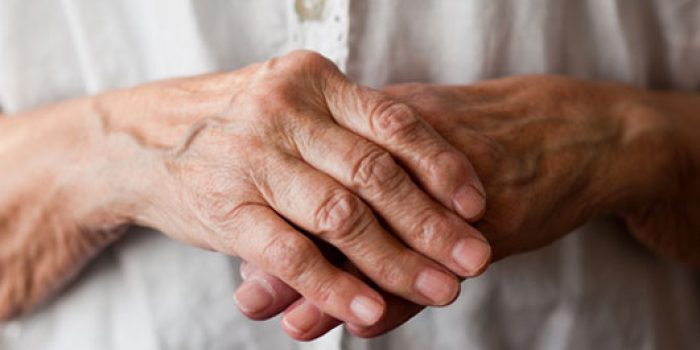 arthritic-hands