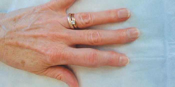 arthritis-on-fingers-pictures-i2