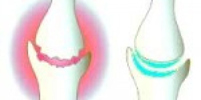 آرتروز, ساییدگی مفصلی, تخریب وغضروف مفصل