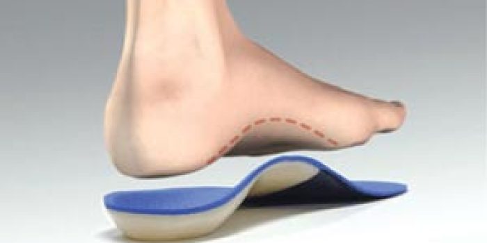 قوس کف پا, کلا فوت, مشکلات قوس کف پا