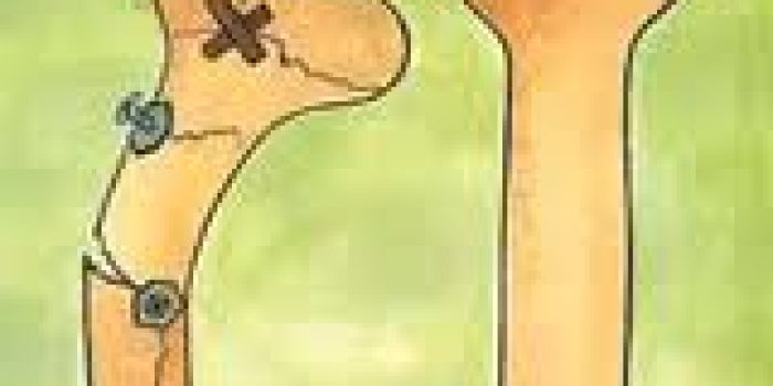 درمان پوکی استخوان