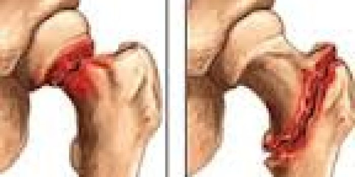 درمان شکستگی گردن استخوان ران