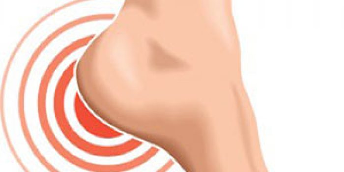 خار پاشنه, درمان خار پاشنه, عوارض خار پاشنه