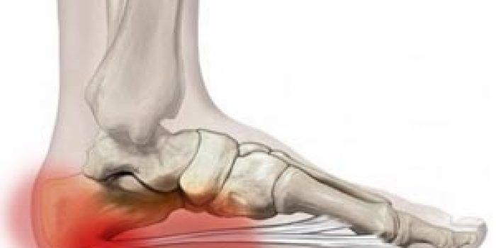 heelpain