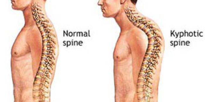 افتادگی شانه