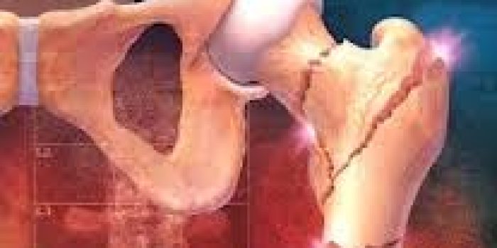 آمار پوکی استخوان