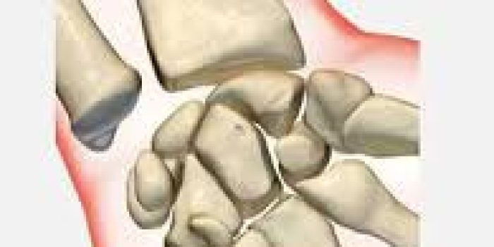 درمان شکستگی مچ دست