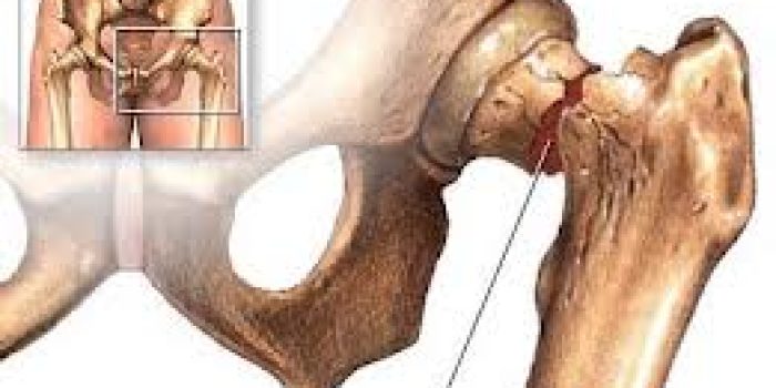 درمان پوکی استخوان