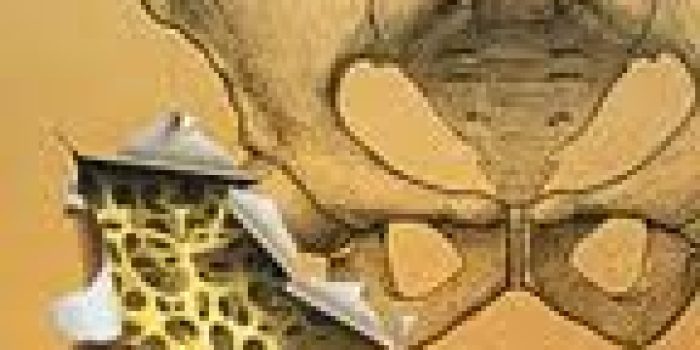 پوکی استخوان