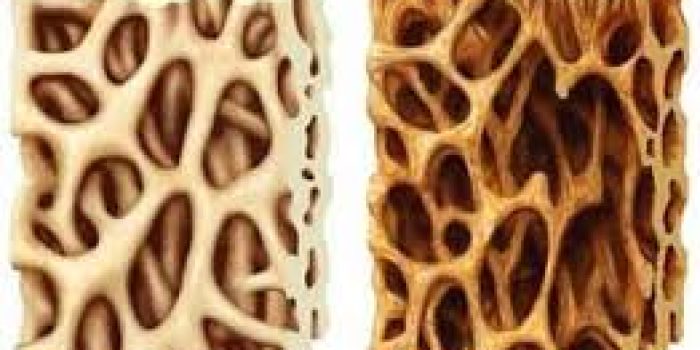 پوکی استخوان