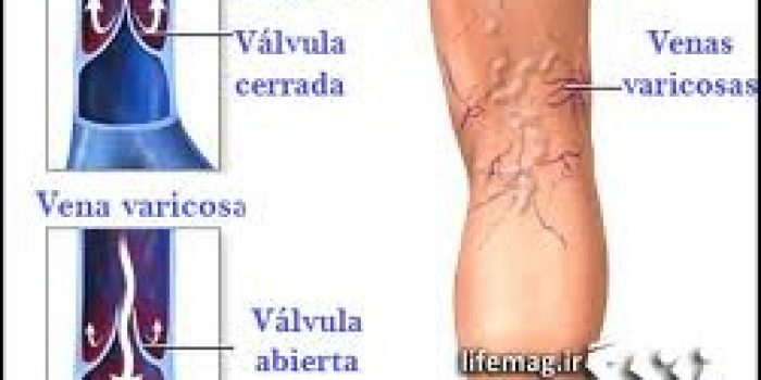 واریس و پیشگیری از آن