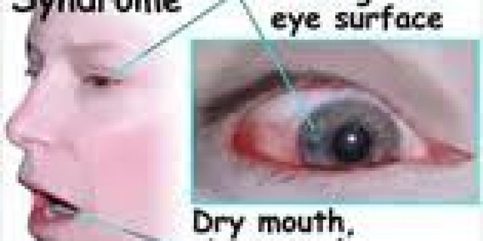 سندروم شوگرن