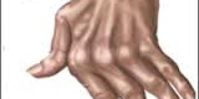 رماتیسم مفصلی