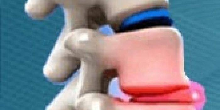 سل ستون فقرات, عفونت در ستون فقرات, علائم سل ستون فقرات