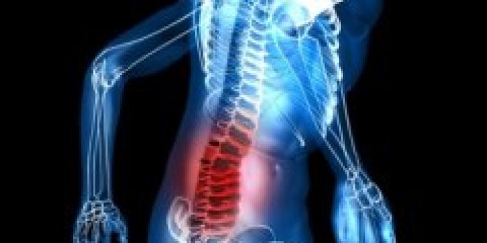 فـتق دیسک کمـر