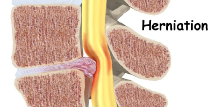 lumbar_stenosis_cause03