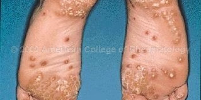 Reactive Arthritis: Keratoderma Blennorrhagica, Feet