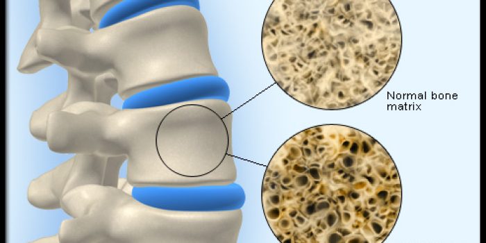 osteoporosis