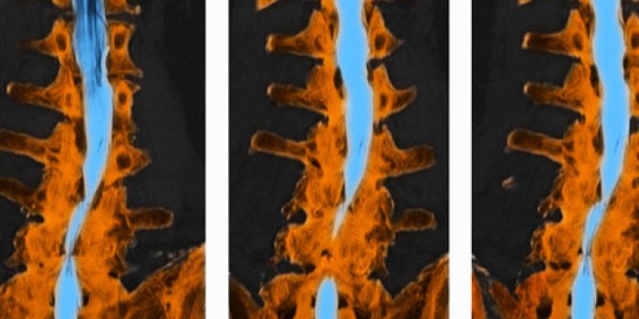 تنگی کانال نخاع