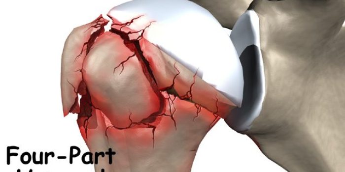shoulder_humerus_fx_4-part