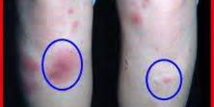 التهاب مفاصل