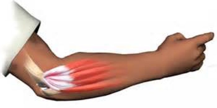 آرنج تنیس بازان, تنیس البو,درمان بیماری آرنج تنیس بازان