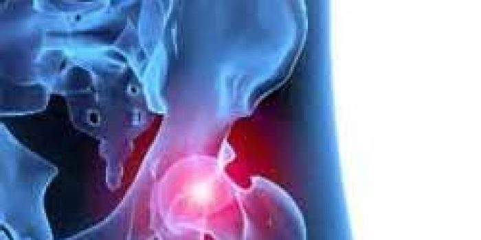 درد لگن, علت درد لگن, درمان درد لگن