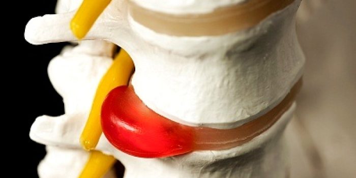 بیرون-زدگی-دیسک-کمر+درمان