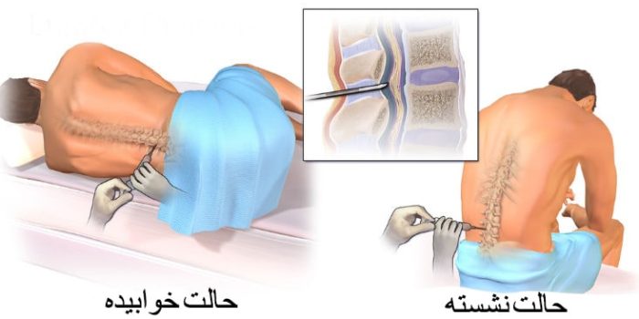 تزریق اپیدورال استروئید به کمر