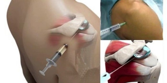 تزریق گاز اوزون در شانه به همراه فواید و نحوه ی درمان