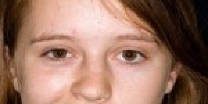 تشخیص-فلج-صورت-150x150