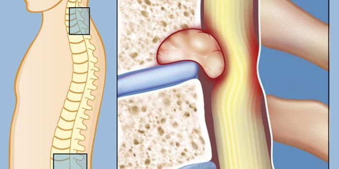 تومورهای ستون فقرات