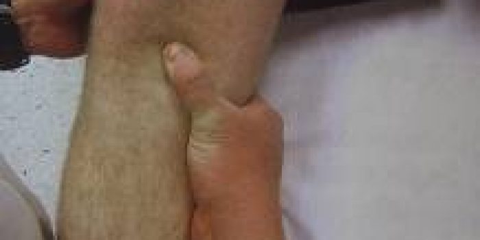 در-رفتگی-مفصل-زانو2