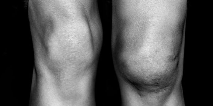 دررفتگی زانو