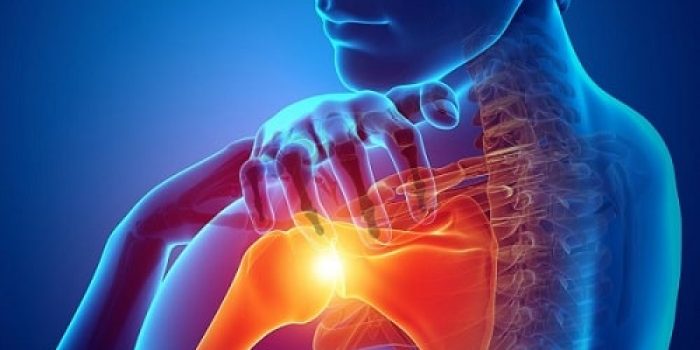 درمان تاندونیت شانه