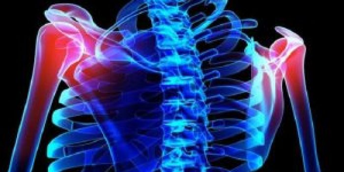 درمان شانه‌های نابرابر به علت وضعیت نادرست و اختلالات عضلانی شانه