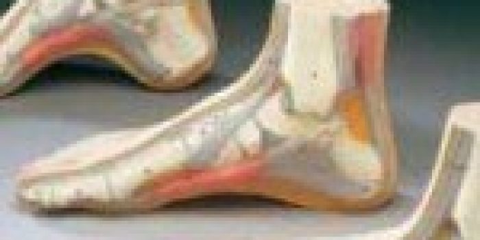 درمان صافی کف پا