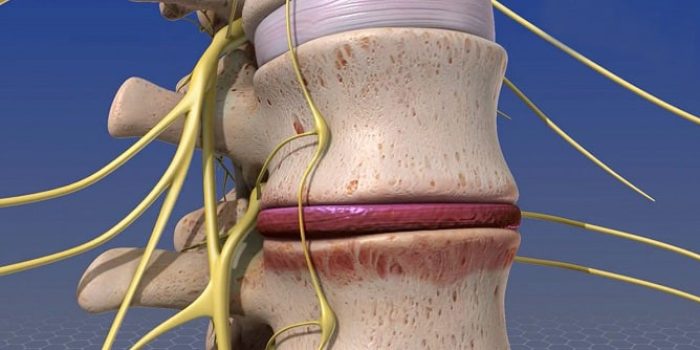 درمان عفونت ستون فقرات (مفاصل و مهره) با آنتی‌بیوتیک و بریس