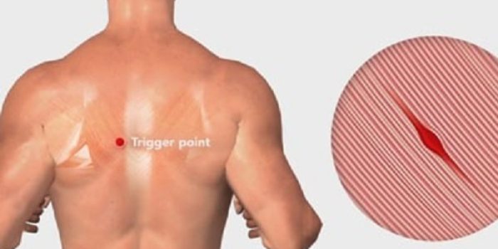 درمان نقاط ماشه ای شانه(گره های عضلانی)با تزریق مفصل شانه و ماساژ-