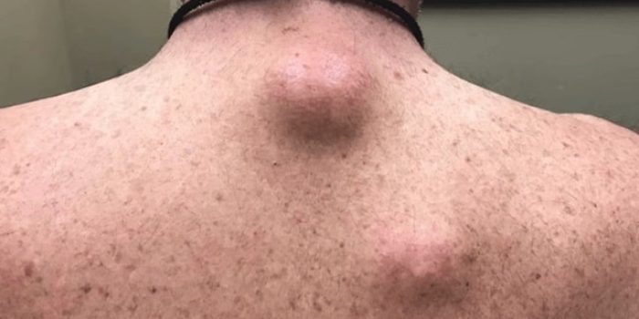 درمان کیست گانگلیون و پارالابرال(چربی روی شانه)