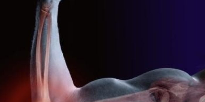 راه‌های درمان و علائم آرتروز آرنج