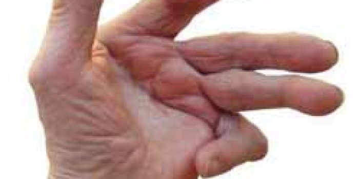 رماتیسم-مفصلی