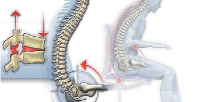 روش-های-درمان-فتق-دیسک-بین-مهره-ای