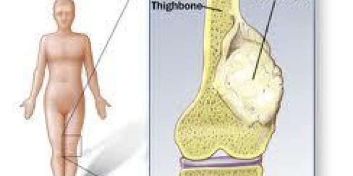 سرطان استخوان 566
