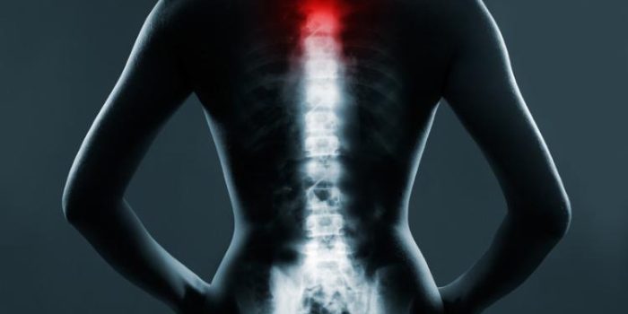 سندروم دم اسبی نخاع