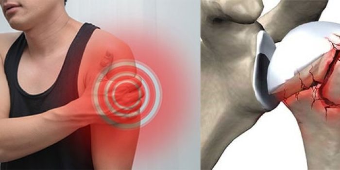 شکستگی استخوان شانه با فیزیوتراپی و جراحی مفصل داخلی و خارجی ترقوه