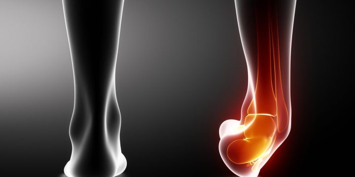 شکستگی استخوان مچ پا1