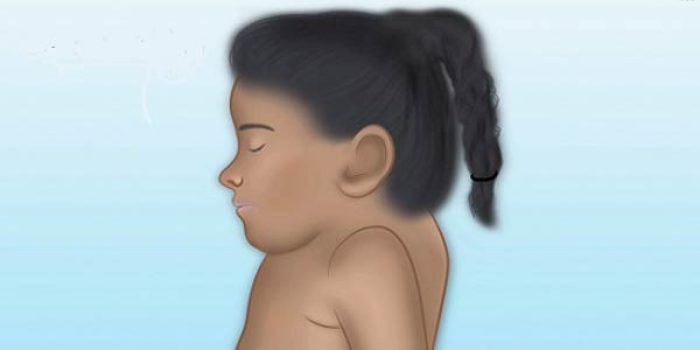 علت، علائم و درمان کوتاه گردنی (سندروم کلپل فایل)