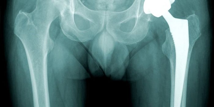 فیزیروتراپی قبل و بعد از جراحی تعویض مفصل لگن(آرتروپلاستی)