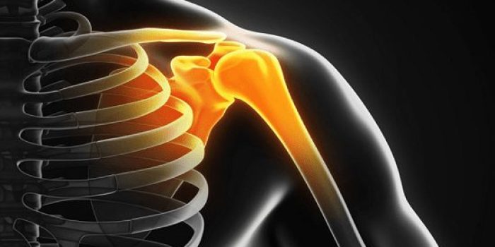 پارگی لابروم شانه به علت صدمه به غضروف در ورزش های سنگین و تصادف